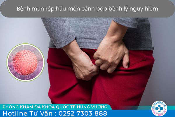 Chớ coi thường bệnh mụn rộp hậu môn - Dấu hiệu cảnh báo bệnh lý nguy hiểm
