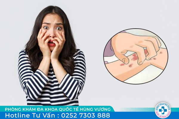 Hình ảnh các giai đoạn mắc bệnh giang mai