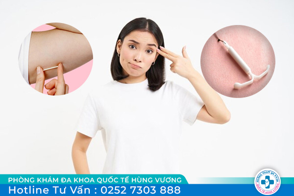 Nên đặt vòng hay cấy que để tránh thai hiệu quả?