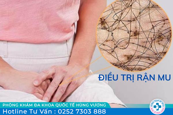 Dấu hiệu nhận biết và điều trị rận mu