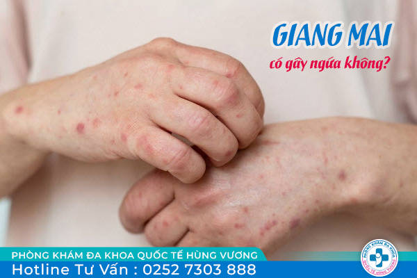 Giang mai có ngứa không? Phải làm sao để điều trị căn bệnh này?