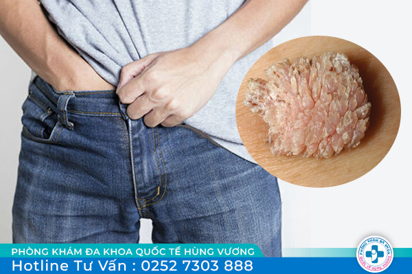 Sùi mào gà ở nam giới sẽ có biểu hiện gì?