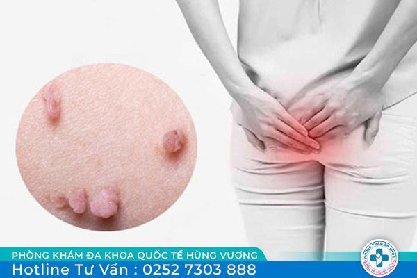 Nổi thịt thừa hậu môn là bị gì? làm sao để điều trị?