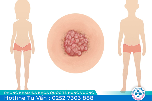 Trong thời gian ủ bệnh sùi mào gà có lây không và cần điều trị thế nào?